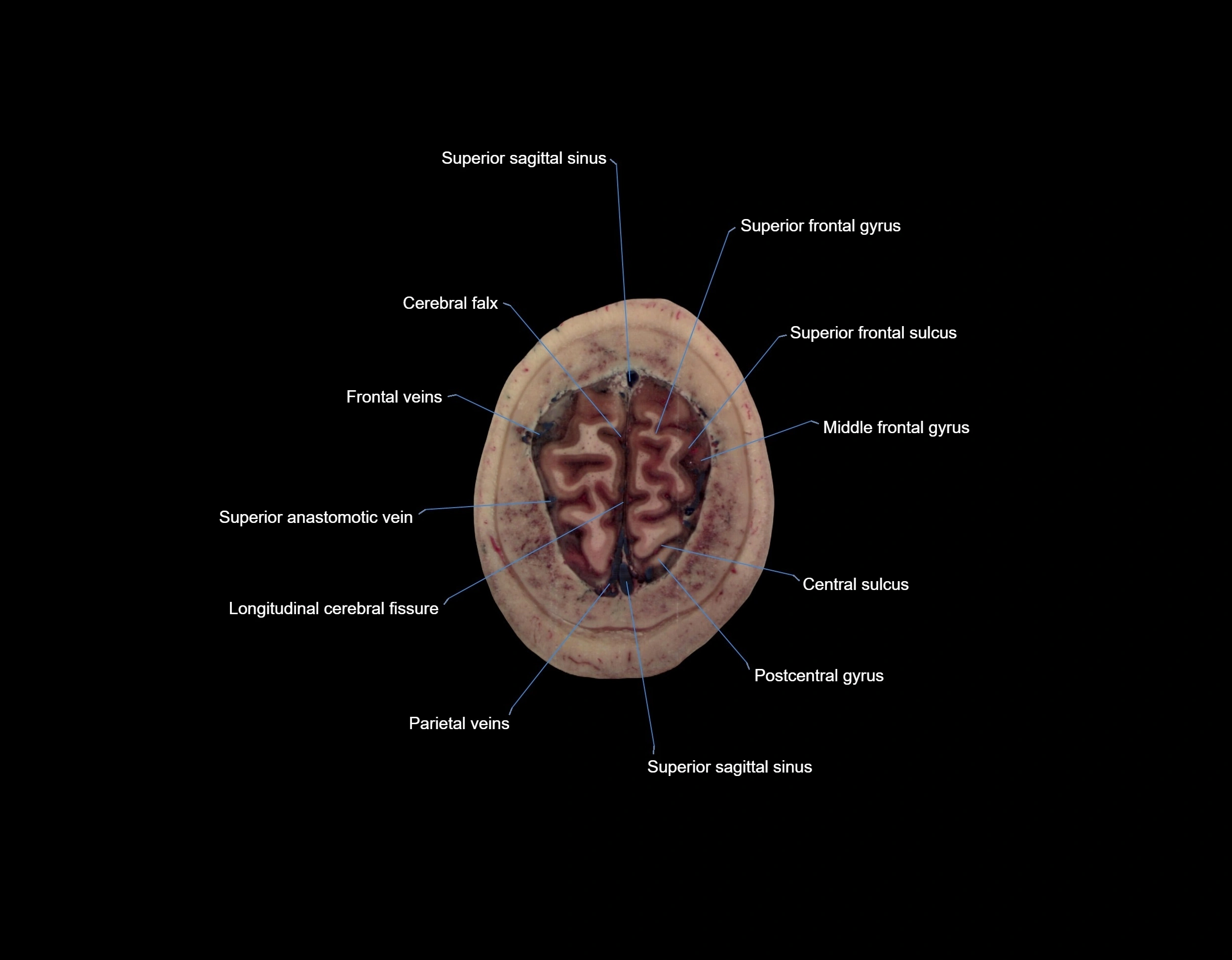 MRI Brain axial cross sectional radiology anatomy 3T image  -img-000072.webp
